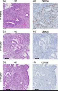 Lee más sobre el artículo Endometritis crónica y biopsia CD138: lo que nadie te ha explicado todavía